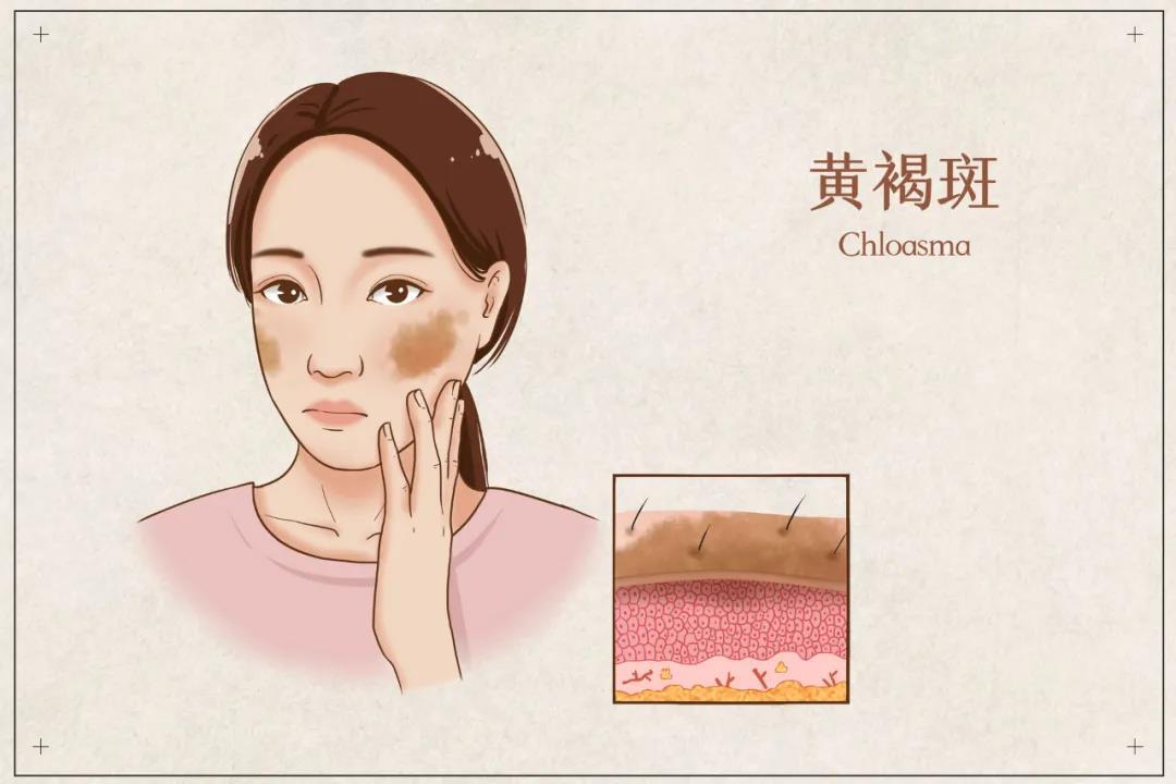 褐斑用什么药好得快,褐青斑中医怎么治