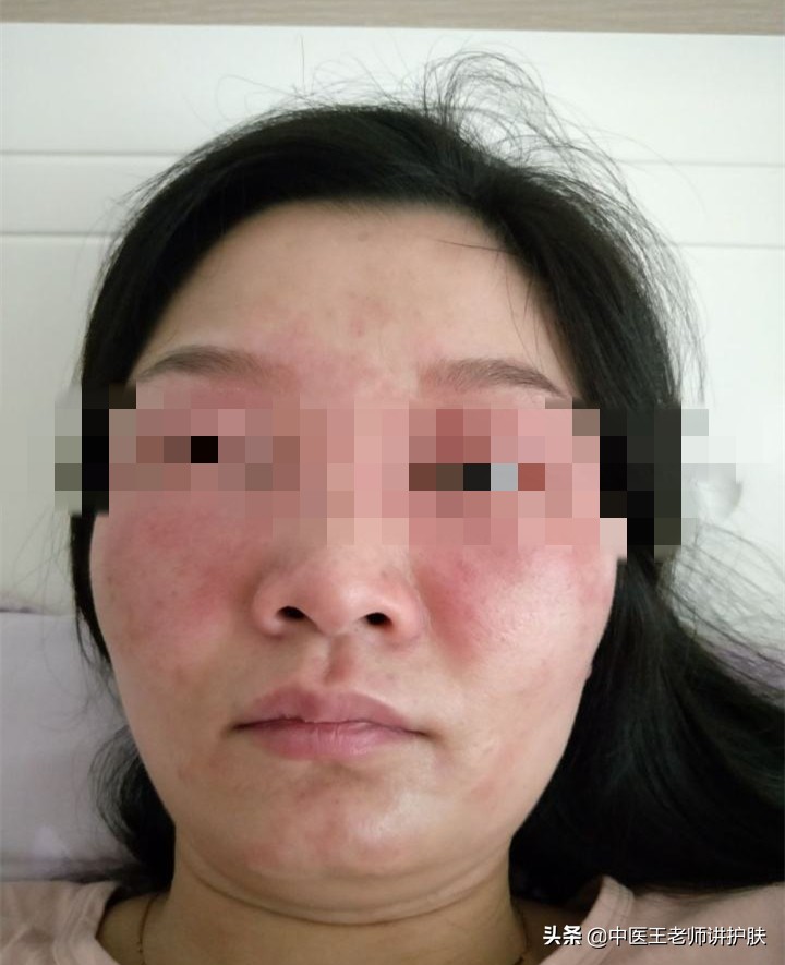 面部激素依赖性皮炎最佳治疗方法,面部激素依赖性皮炎能治好吗