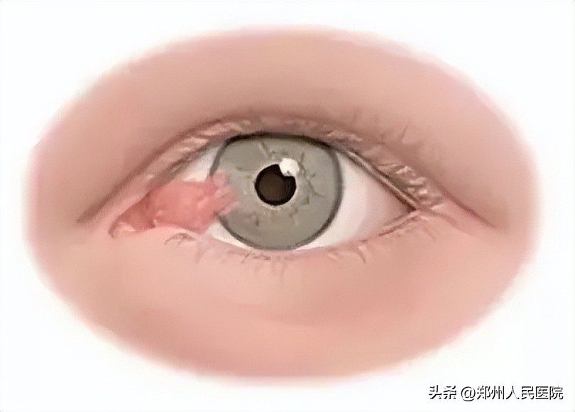 眼球突出恐怖图,眼球上长黄色凸起物怎么回事