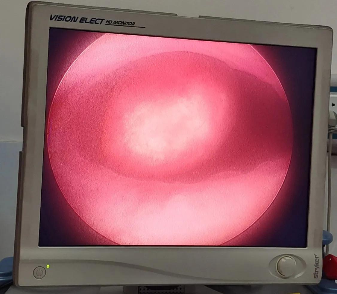 好好的子宫内膜，怎么就长了“多肉”？