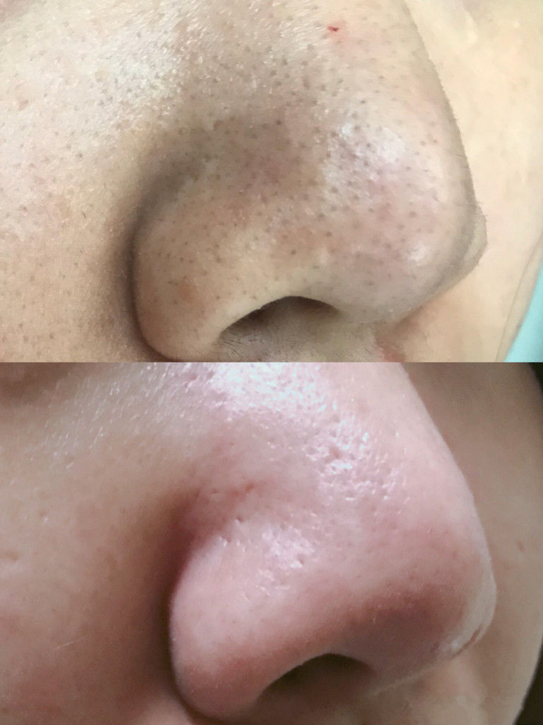 鼻子黑头挤出水一样的液体,鼻子挤黑头粉刺