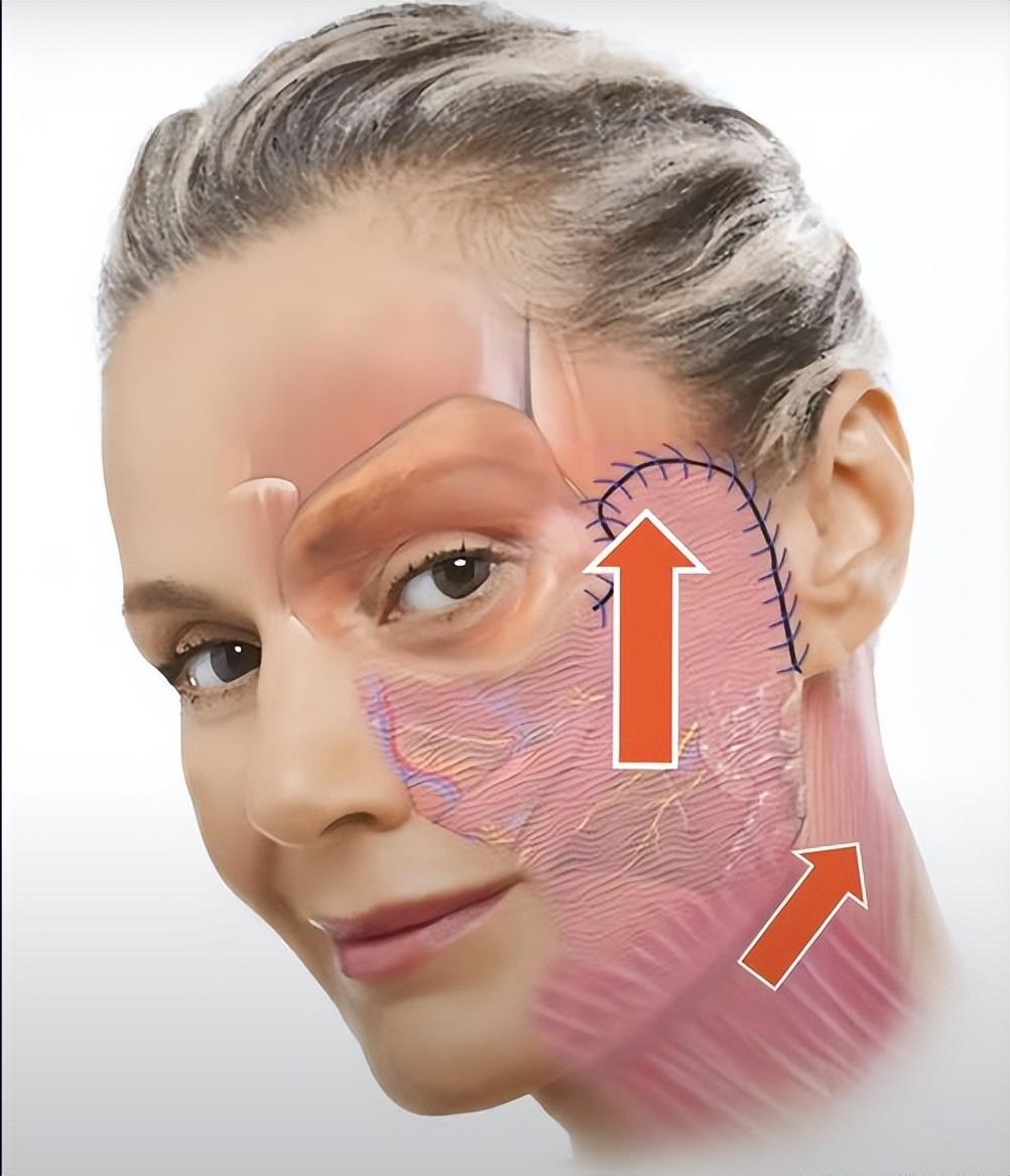 做个面部拉皮手术要多少钱啊,小拉皮手术后多久能恢复自然