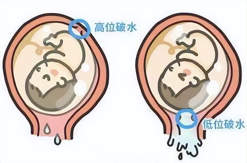 孕晚期如果破水了怎么办,孕晚期如果破水了怎么处理