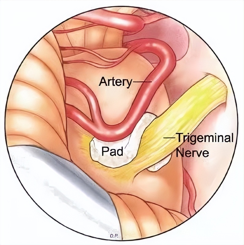 三叉神经引起的牙痛怎么快速止痛,三叉神经痛吃什么祛风止痛的药