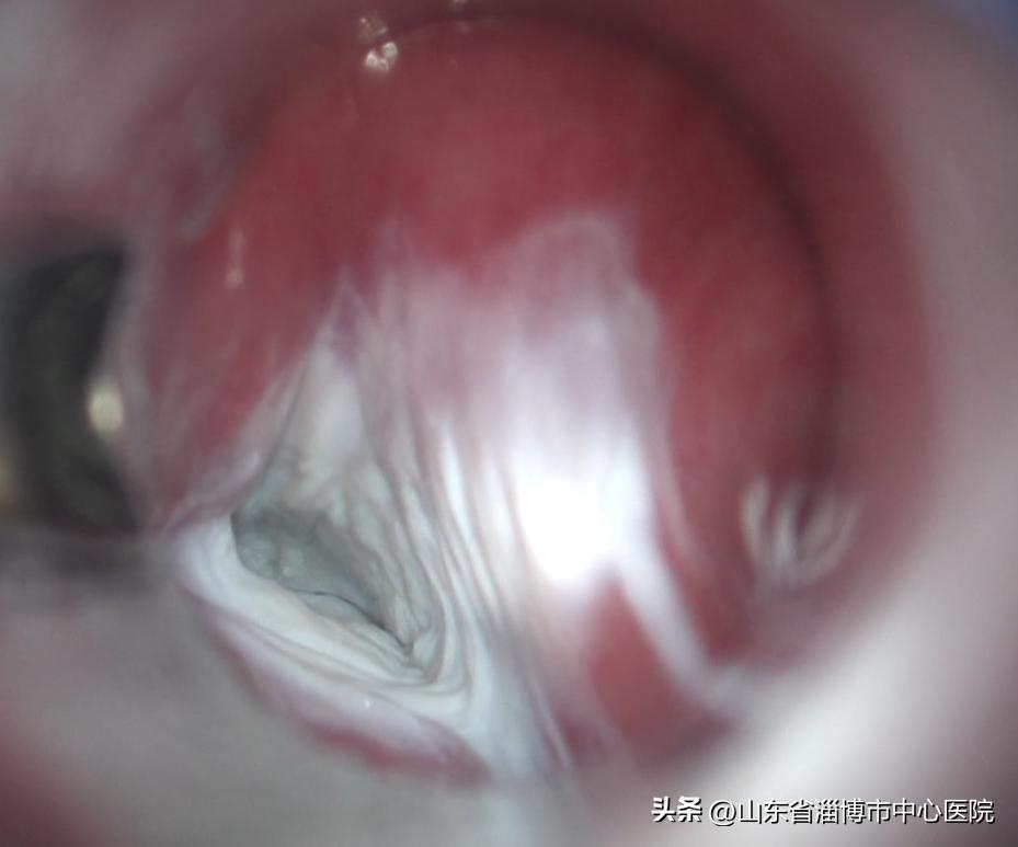 咽喉微创手术县级医院能否做,咽喉部的微创手术
