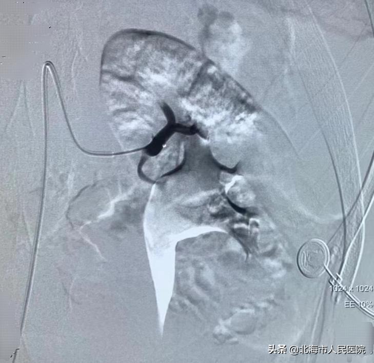 一名男子骑摩托车事故右腿骨折,男子骑摩托车摔成骨折