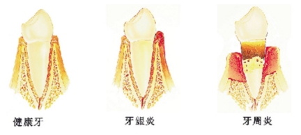 美恒小科普：牙龈肿痛真难受，只是上火引起的吗？真相没那么简单