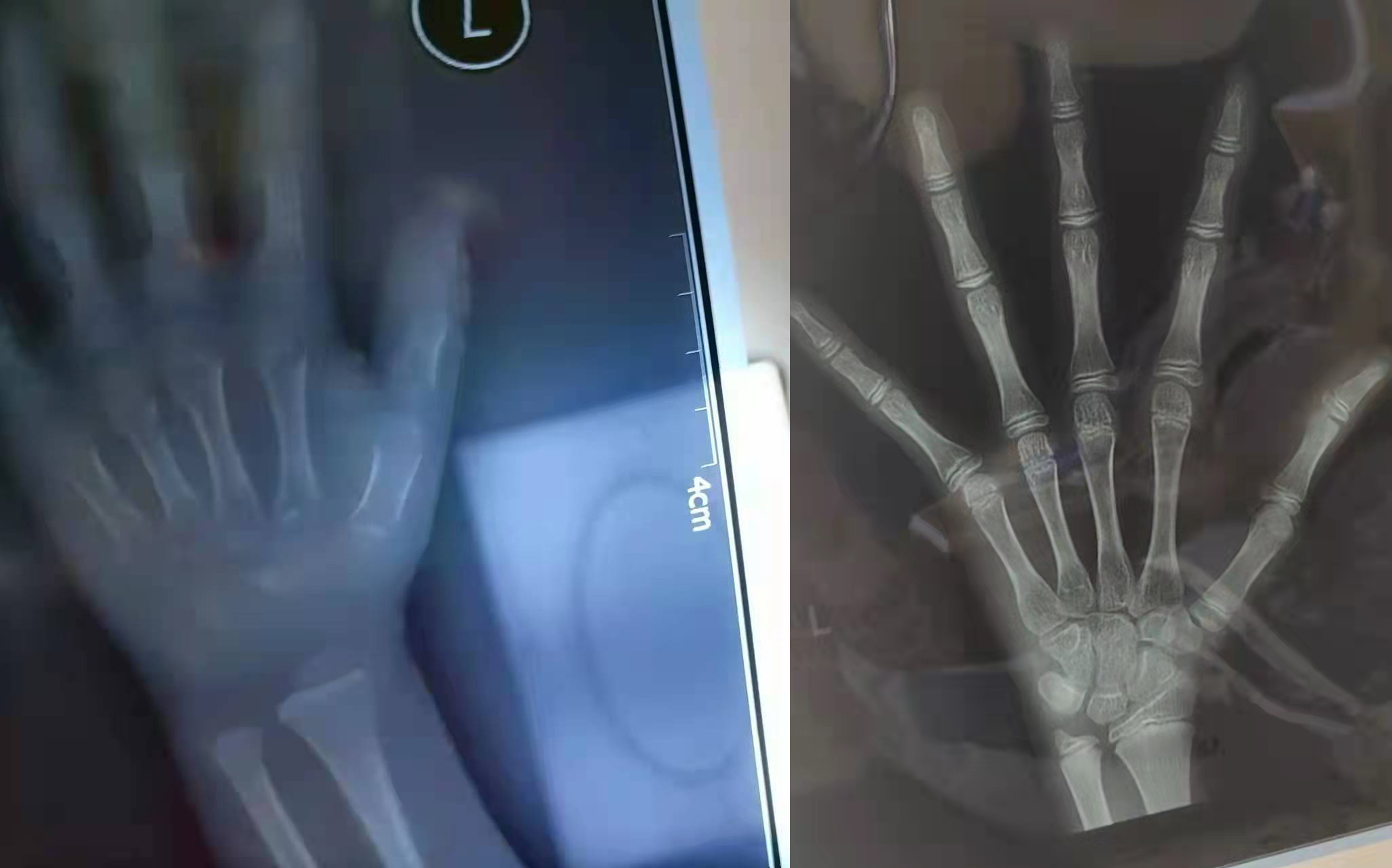 拍骨龄片的正确姿势,如何通过骨龄片看骨龄