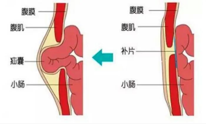 河北省儿童医院小儿疝气,医院开展中国疝气日义诊活动