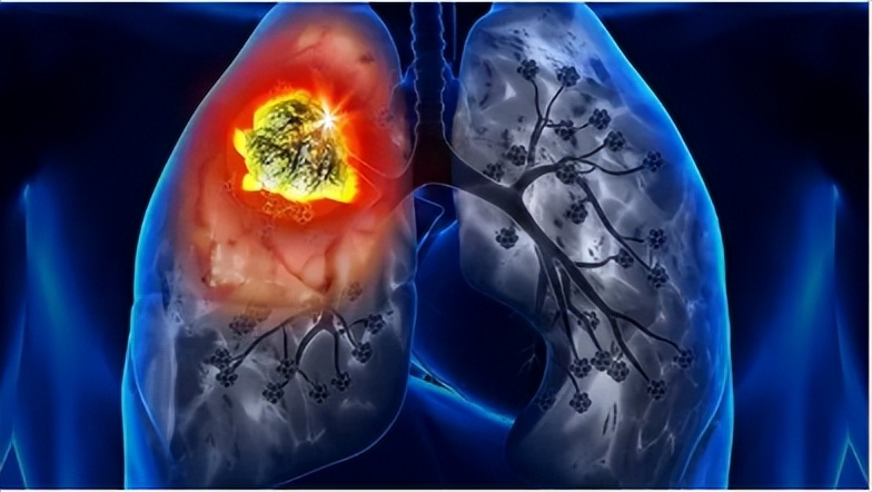 脂肪瘤是身体脂肪高引起的吗,脂肪瘤和脂肪肉瘤区别在哪里