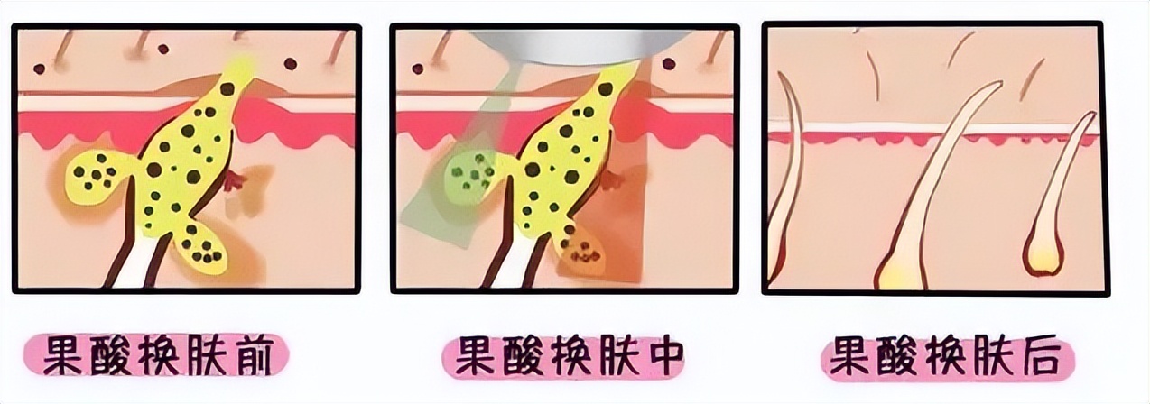 脸上到处是痘痘痘印痘坑怎么办,痘痘破了怎么处理不会留痘印痘坑