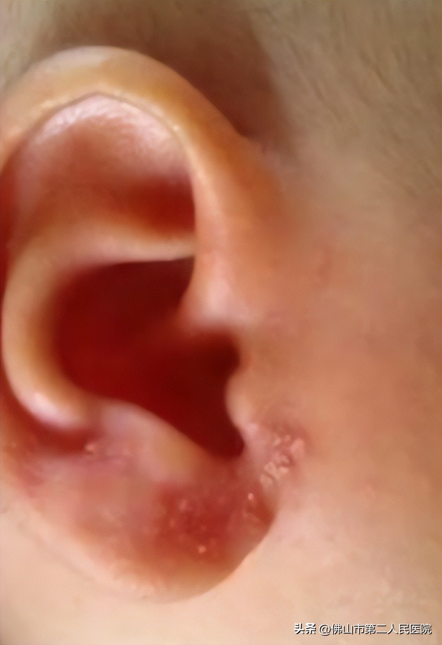 宝宝总是用手抠耳朵是有湿疹吗,宝宝耳朵长湿疹抓耳朵睡不好