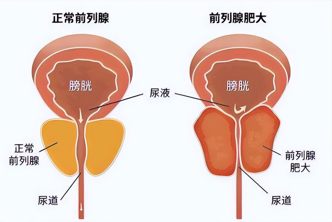 老年人前列腺肥大有必要做手术吗,老年人前列腺肥大疼吃什么药