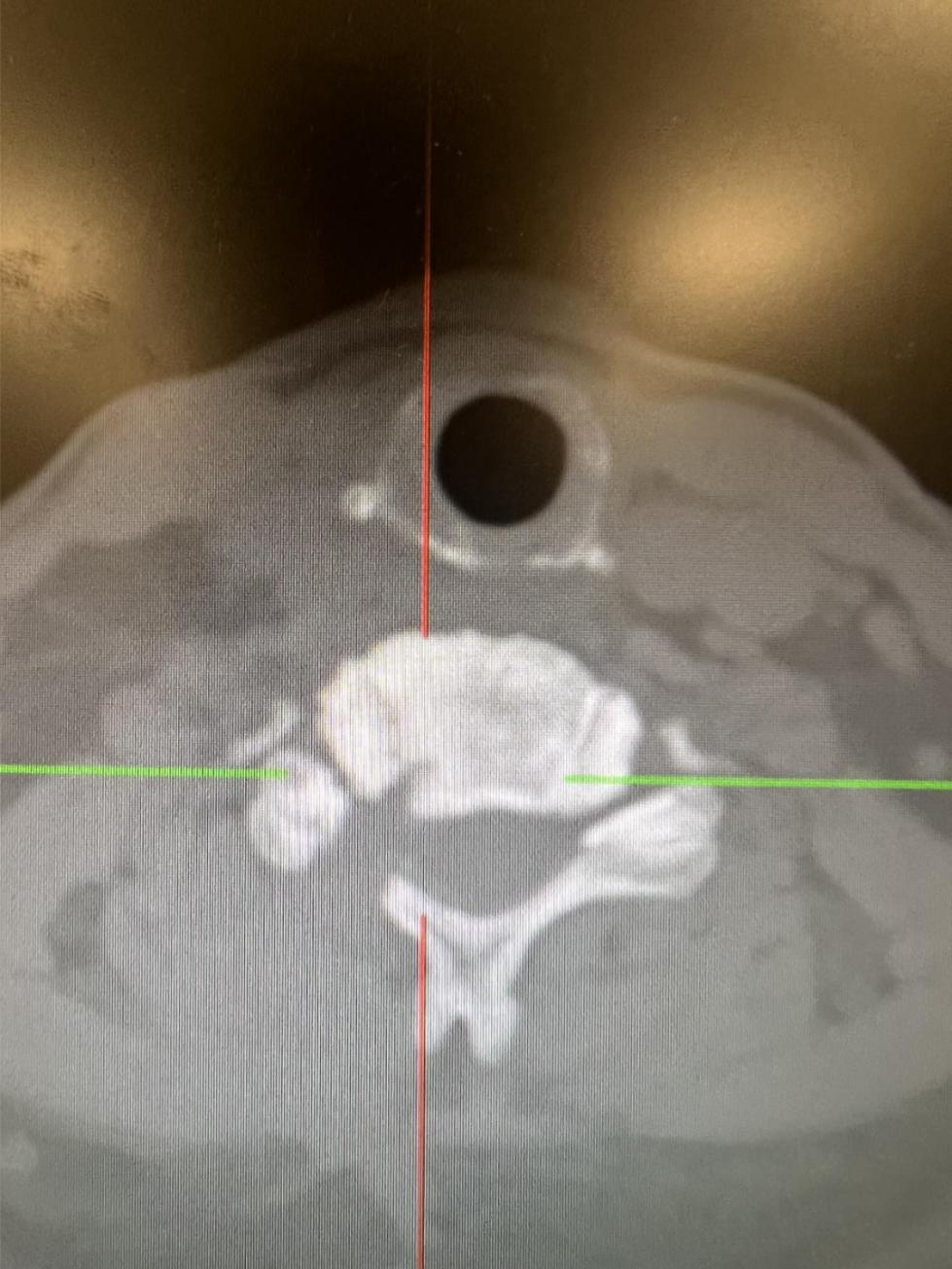 西安椎间孔镜手术治疗颈椎,西安红会医院微创