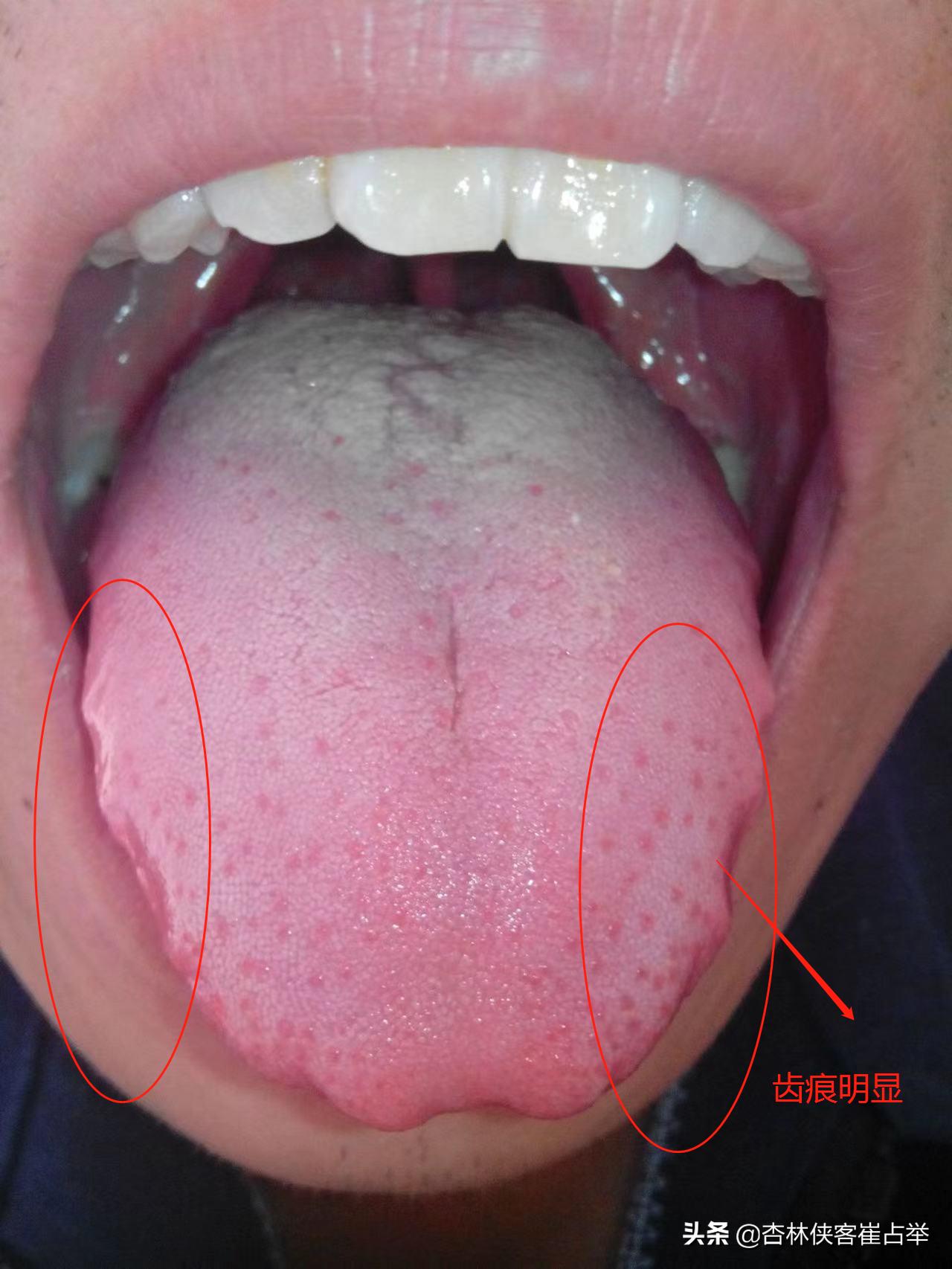 小肚子胀且肠鸣怎么回事,肚子有气胀肚吃什么药