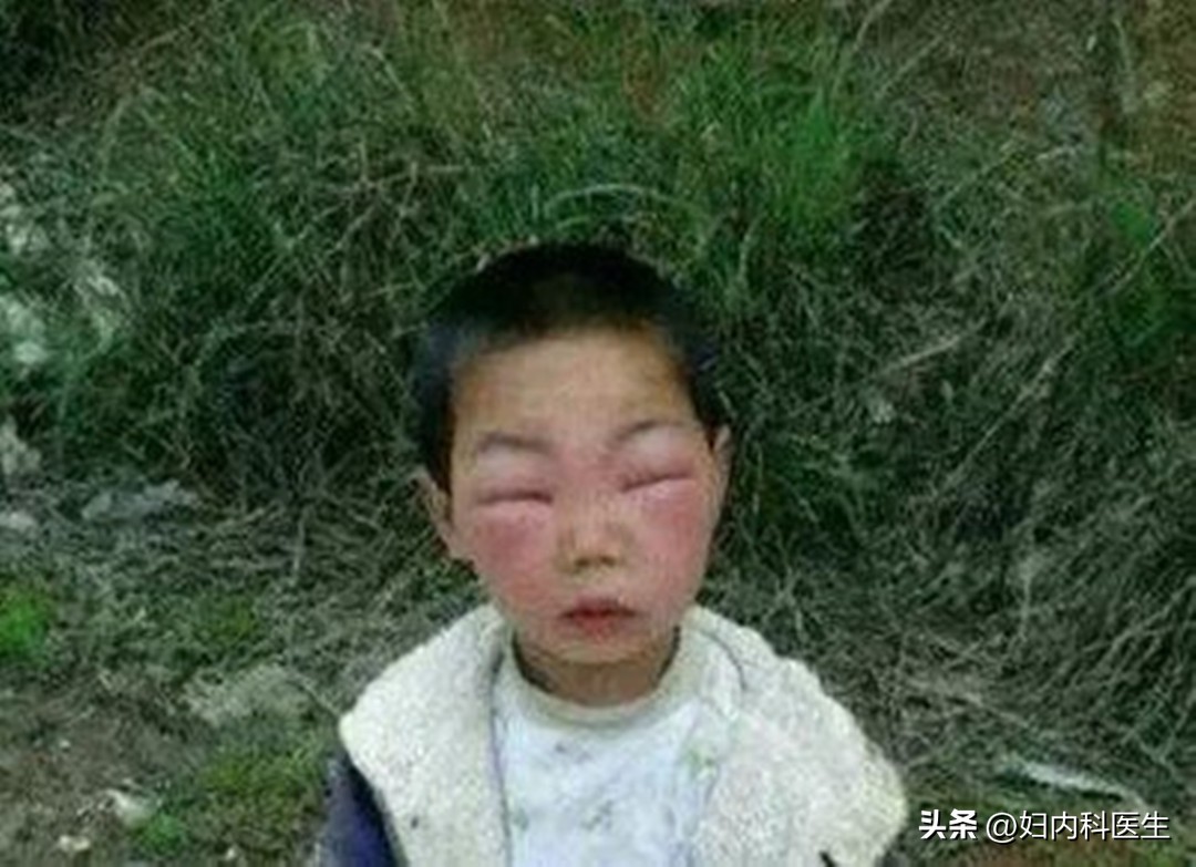 户外被蜂螫后该如何急救,被蜜蜂螫伤了怎么办