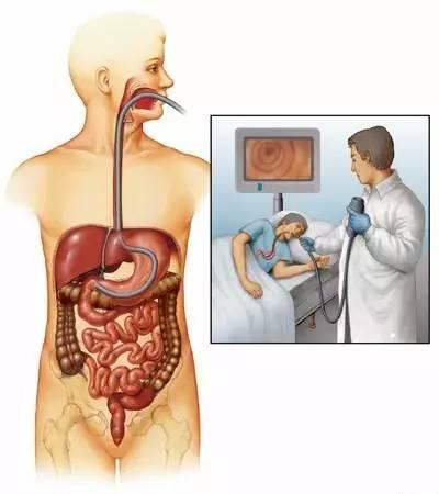 胃镜检查前的注意事项,胃病检查必须做胃镜吗