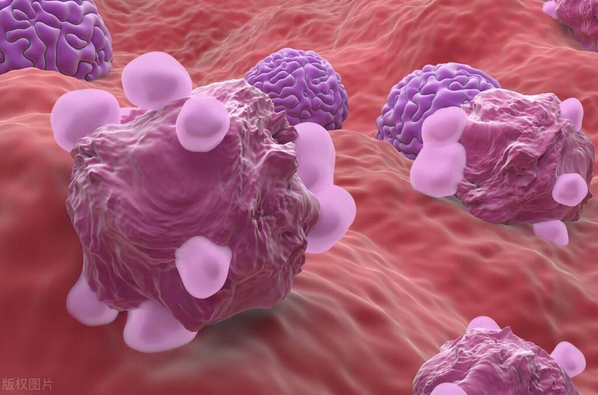 卵巢癌为什么发现就是晚期,卵巢癌一发现就是晚期