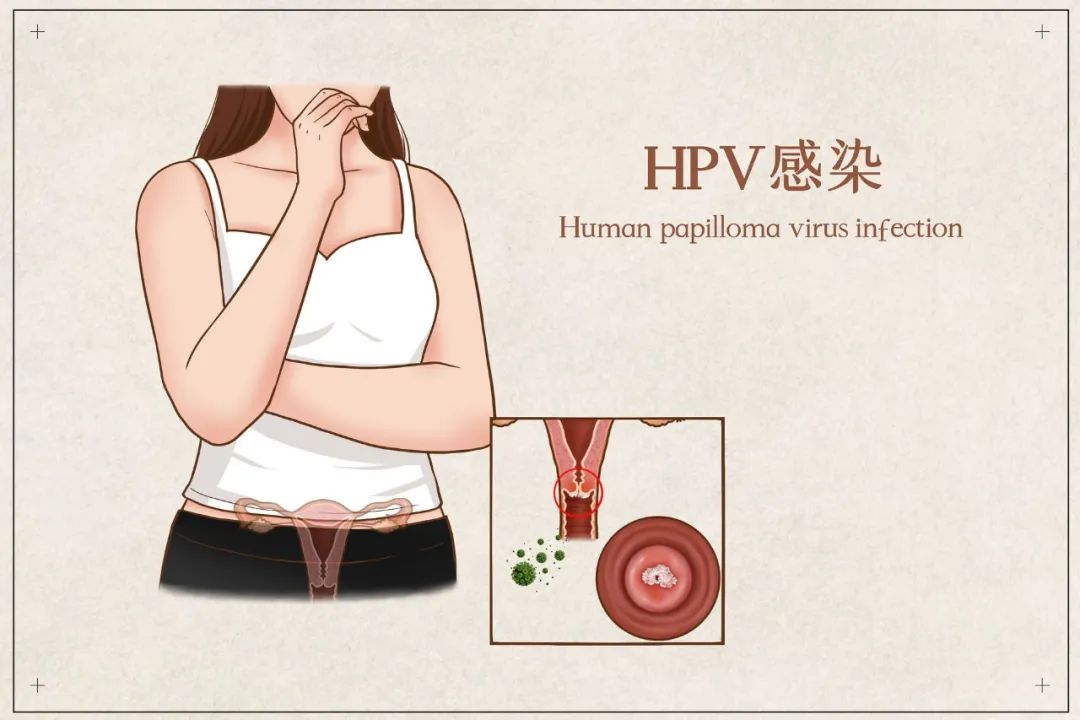 哪些女性容易感染HPV？这七种女性都要注意