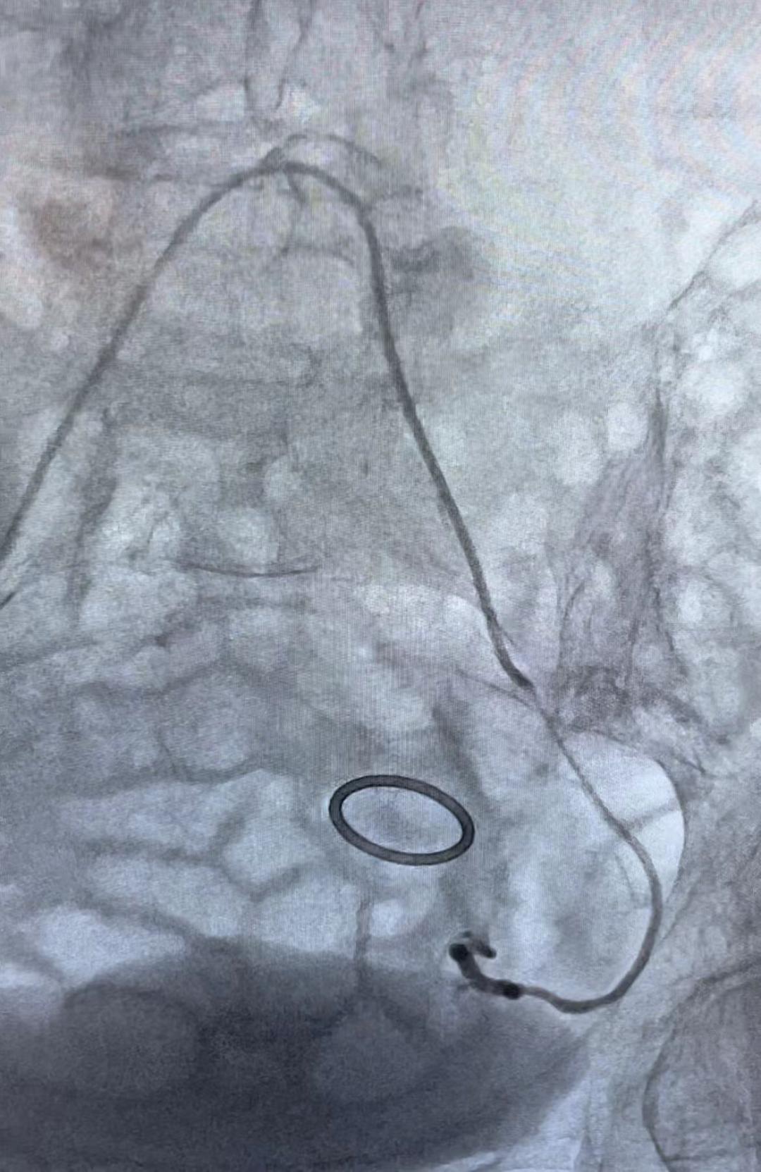 MDT——宫颈癌出血不止时肿瘤科迅速补位救命