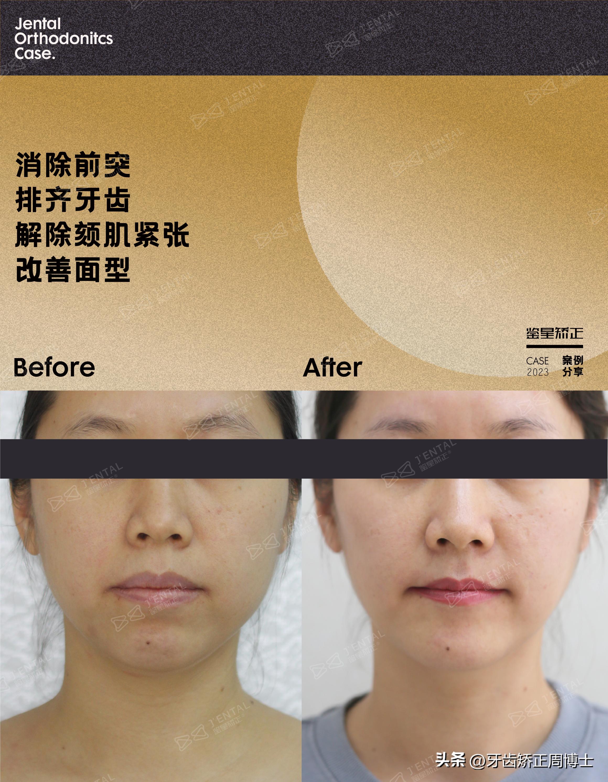 骨性龅牙怎么通过普通的矫正改善,骨钉如何解决骨性龅牙