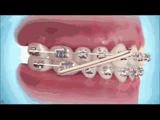 堪比整容式的牙齿矫正,牙齿矫正变美案例