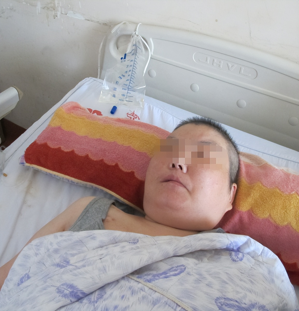 听神经瘤出现脑积水和出血,听神经瘤手术后颅压高症状