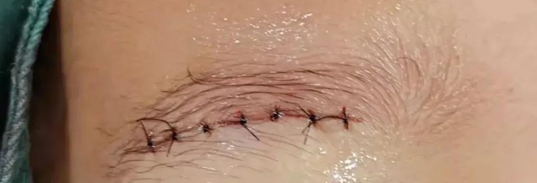 伤口缝合留疤还是不缝合留疤,可吸收的缝合线有疤痕吗