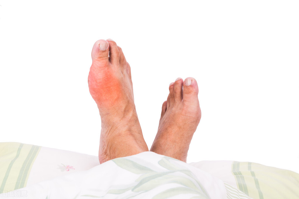 治疗痛风急性发作最适宜的药物是,痛风急性发作后多久能吃降尿酸药