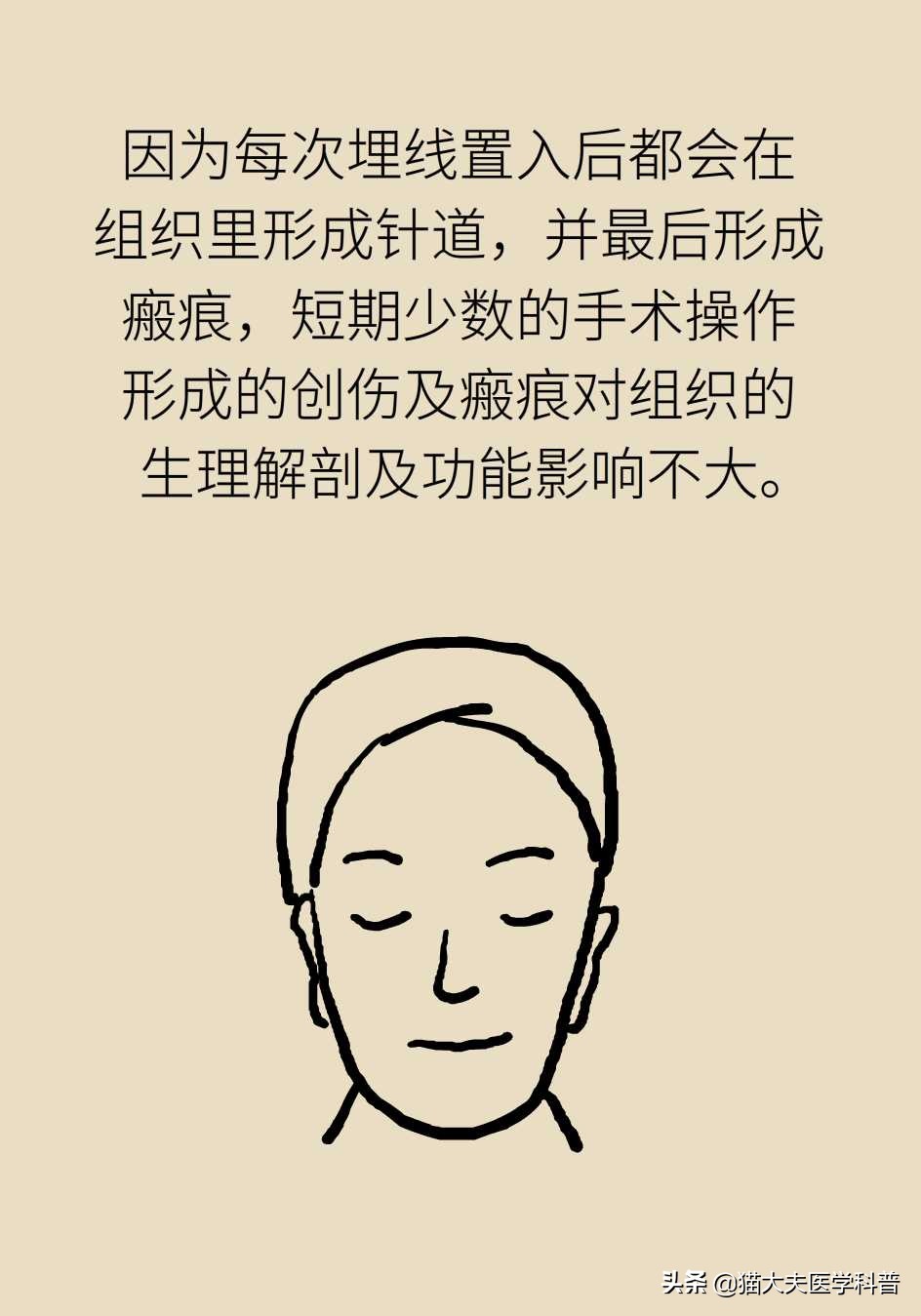 线雕逆龄线可以保持多少年,做了逆生长线雕注意什么