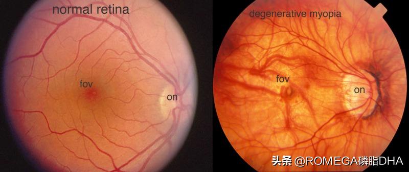 长期戴防蓝光眼镜对眼睛有影响吗,经常戴眼镜眼睛有什么变化吗