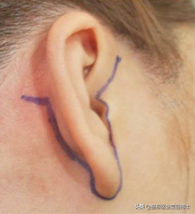 新手医生做拉皮手术可靠吗,北京八大处拉皮手术费多少钱