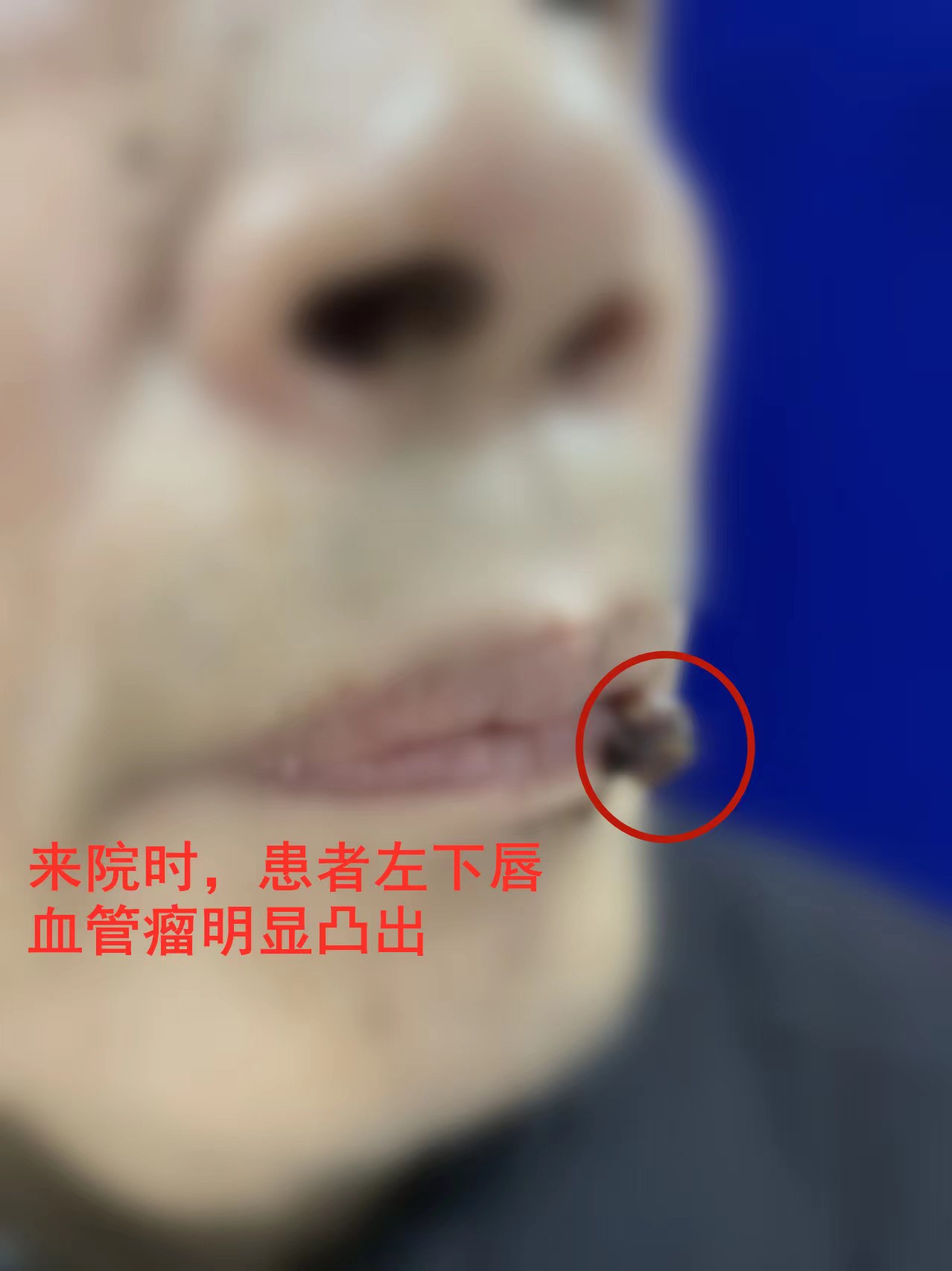 嘴唇冒出小肉球，20天竟暴涨十倍