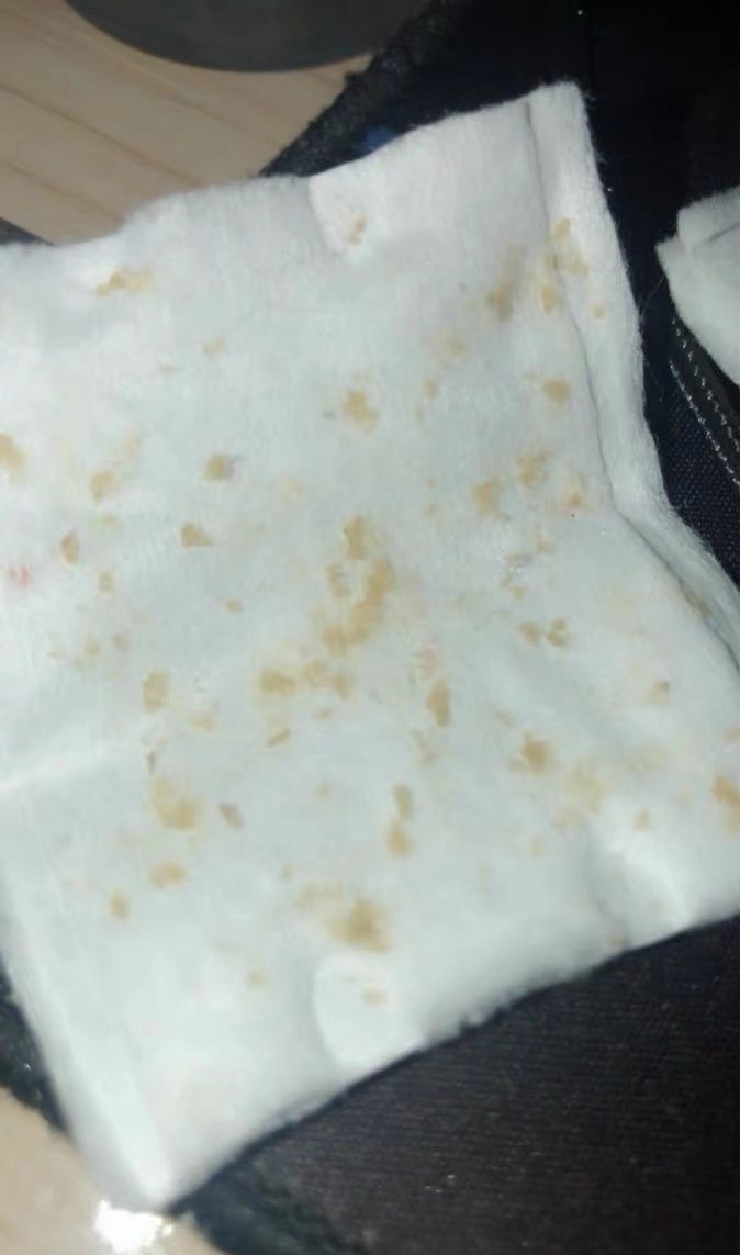 挤鼻子上的黑头和粉刺,鼻子上的粉刺该不该挤