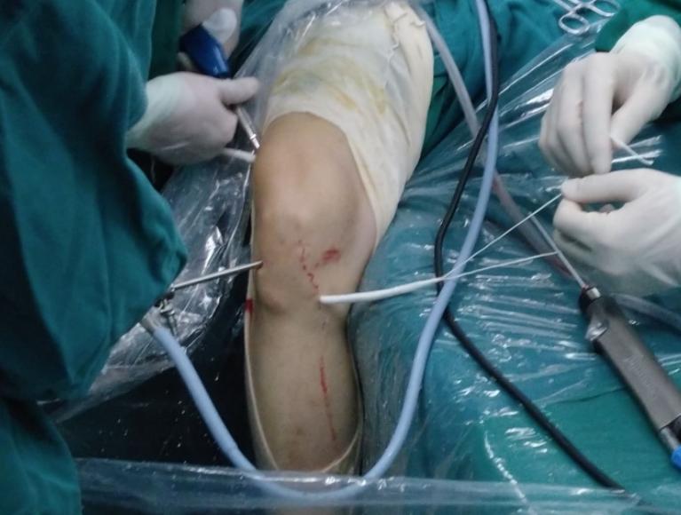 你了解肩袖损伤吗,有前后交叉韧带的是什么