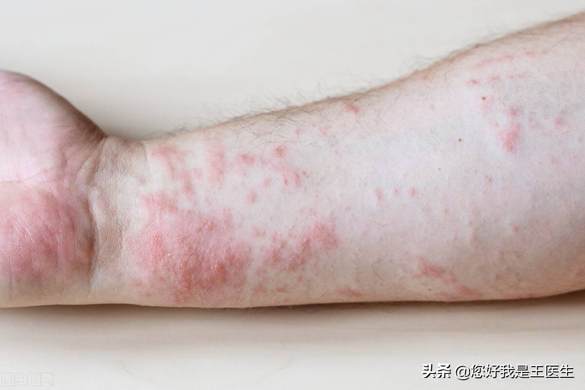 孩子湿疹反复记住这三招,孩子湿疹反复怎么食疗