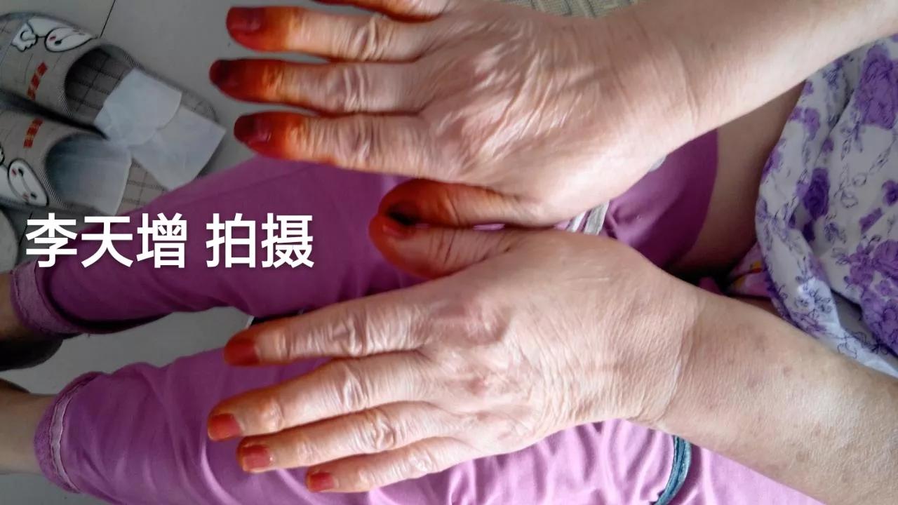 40岁女性手背开始很多皱纹怎么办,手背皮肤松弛皱纹多粗糙是啥原因