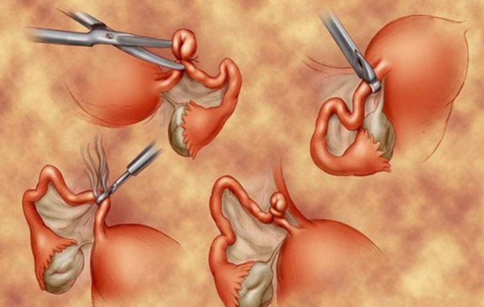 这种避孕方式，一劳永逸，为何外国人都在用，国内却少有人用？