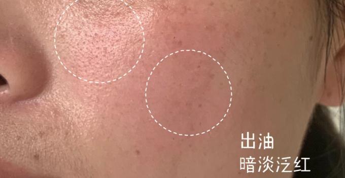 痘痘肌敏感肌良心推荐,痘痘肌敏感肌精华水推荐