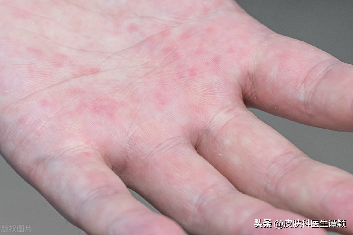 名医讲解汗疱疹的起因和治疗视频,皮肤科汗疱疹