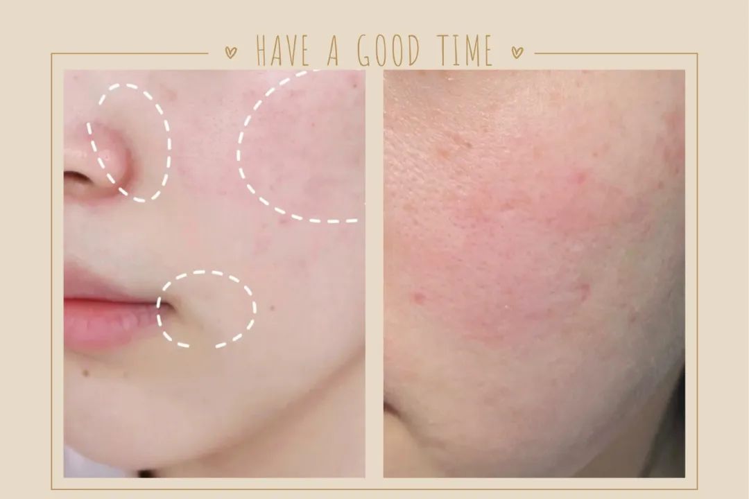 缩毛孔的有效方法,缩毛孔最靠谱的方法