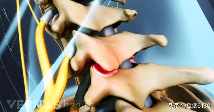 颈椎病导致的手臂酸软无力怎么办,神经根型颈椎病手臂酸胀麻怎么办