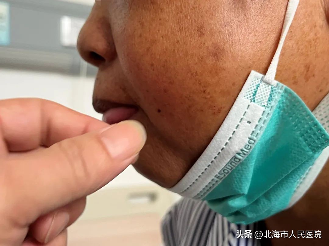 面部突发三叉神经疼,原发性三叉神经痛面部感觉减退