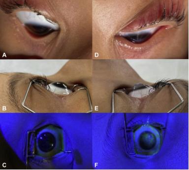 结膜炎引发角膜炎怎么彻底治愈,腺病毒性结膜炎如何治疗
