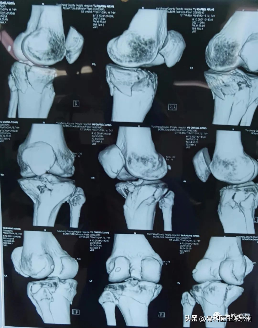 膝关节胫骨平台骨折,最近胫骨平台骨折视频