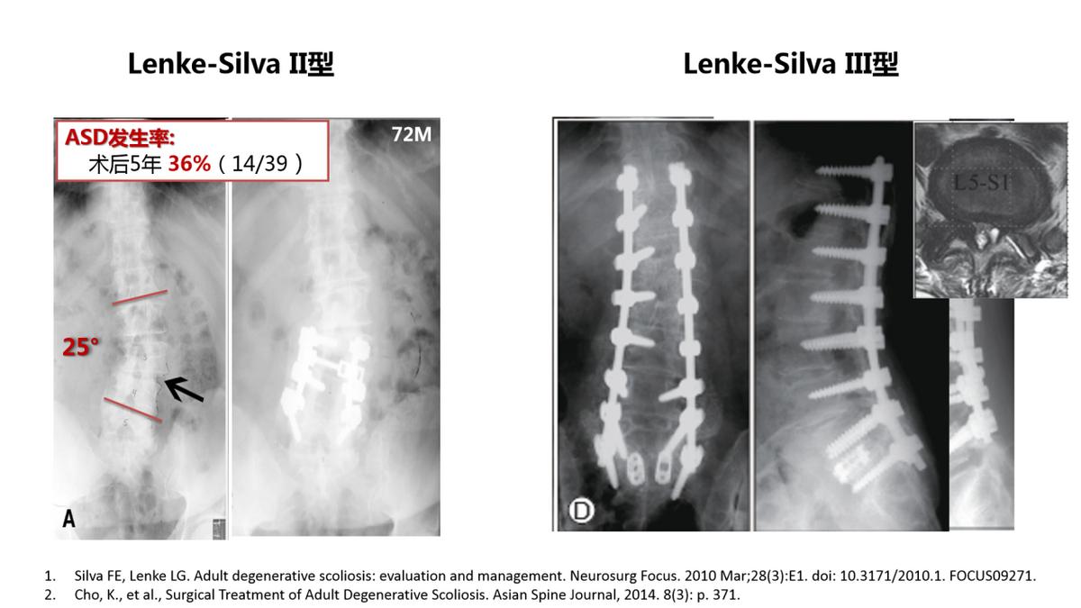 老年人脊柱侧弯的危害和症状,老人脊柱侧弯腰部疼痛怎么缓解