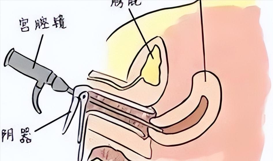为什么不孕不育要做宫腔镜,不孕不育什么情况下做宫腔镜