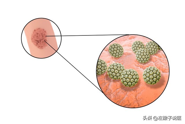 脖子上的“小肉球”是怎么一回事？可以用手抠掉吗？告诉你答案