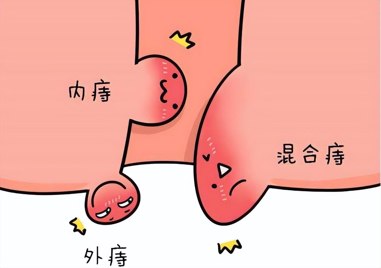 菊花痒到坐立难安?可能是肛毛太多惹的祸