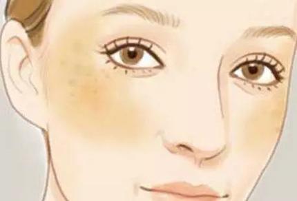 色斑有多少种,色斑小常识